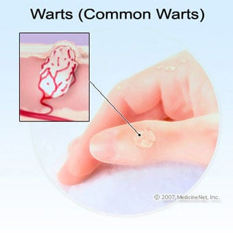 Illustration of a wart on the thumb with a callout detail.
