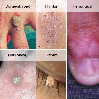 Examples of (1) dome-shaped wart, (2) plantar wart, (3) flat (plane) wart, (4) periungual wart, and (5) filiform wart.