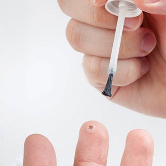 Treating a wart with salicylic-acid application.