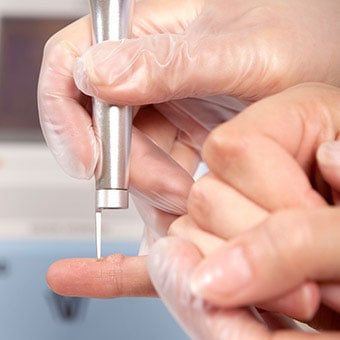 Laser surgery removal of a wart on a finger.