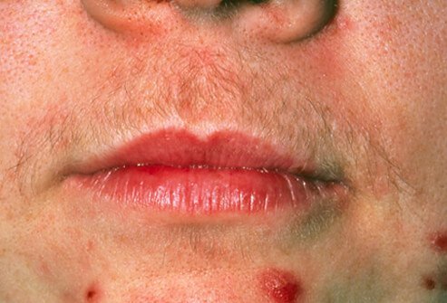 Polycystic ovary syndrome, or PCOS, is a hormonal condition that affects women of reproductive age.