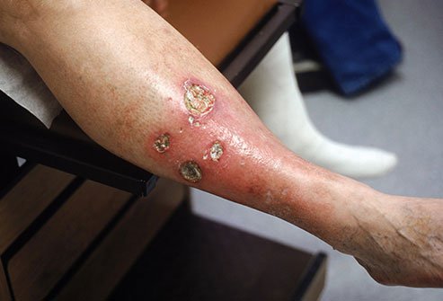See your doctor if you develop leg ulcers, which can become infected.