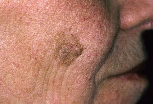 Seborrheic keratosis also occurs with aging skin.