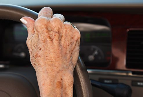 Age spots on the skin are more common after the age of 50.