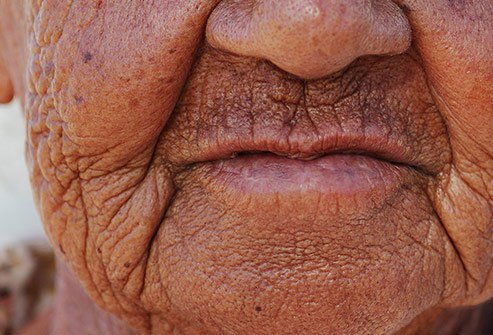 Skin yellowing and deep ridges are hallmarks of solar elastosis, a skin ageing condition.