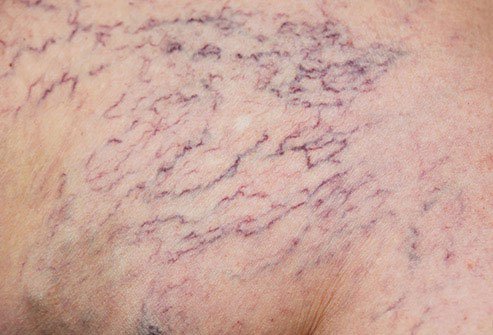 Spider veins are like varicose veins but they are smaller.