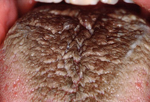 Poor oral hygiene, smoking, some mouthwashes, radiation therapy to the head and neck, and certain medications can play a role.