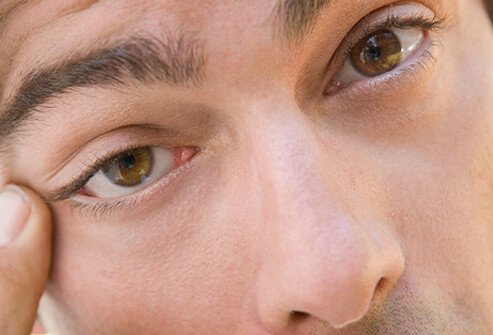 Eyelid spasms are unpredictable, bothersome, and harmless.