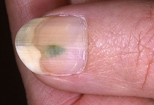Yellowish nails are often a sign of fungus.