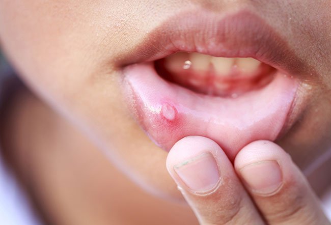 Blisters on the lips can be caused by accidentally biting your lips, burning your lips with a hot surface or food, brushing your teeth too vigorously, or getting infected by a virus.