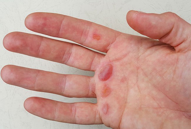 The most common causes of blisters on the hand include eczema, friction injury, irritation from chemicals or allergens, medication reaction, infections, burns, or diabetes.