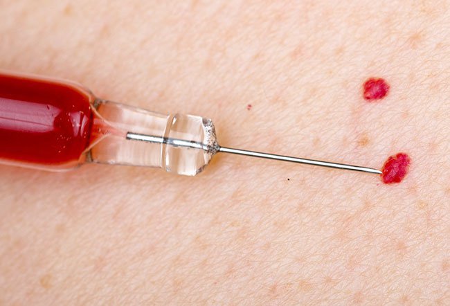 Cherry angiomas are noncancerous red bumps that form due to the clustering of blood vessels on the skin. Cherry angiomas are a sign of age, certain medical conditions, chemical exposure, climate factors and pregnancy.