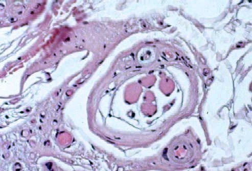 A muscle biopsy is used to diagnose a neuromuscular disorder like Parkinson's, multiple sclerosis, or Huntington's disease.
