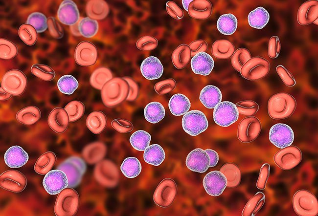 A myelodysplastic syndrome (MDS) is a type of blood cancer in which the blood-forming cells of the spongy part of the bone become abnormal.