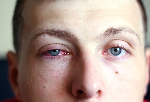 Eye infections can be bacterial or viral. They typically cause redness, swelling, discharge, watery eyes or general discomfort in the eyes.