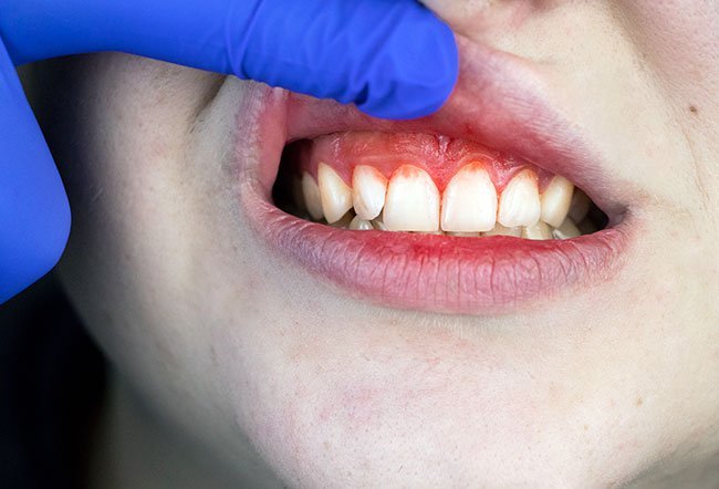 Early signs of periodontitis is a buildup of plaque on and between your teeth. Periodontitis is identified by bad breath, and gum and teeth issues.