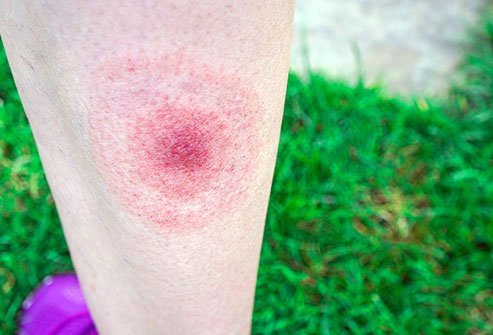 Lyme Disease