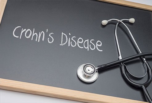 Crohn's disease is an inflammatory bowel disease with five types, classified based in symptoms and the general location of the inflammation in the intestine.