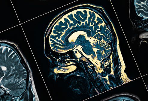 There are several different kinds of schizophrenia each with slightly differing symptoms.