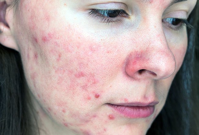 There is no cure for rosacea, but it can be treated and managed with medications, self-care practices, and avoiding triggers. 