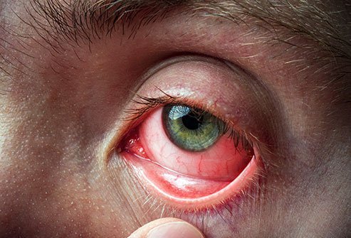 Allergic conjunctivitis is the medical term for an eye allergy. Treatments for allergic conjunctivitis include antihistamines and mast cell stabilizers.