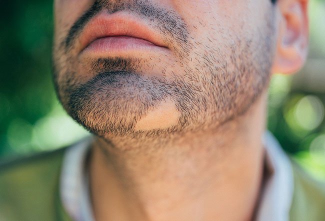 There is no cure for alopecia areata, but there are treatments available that some people find beneficial.