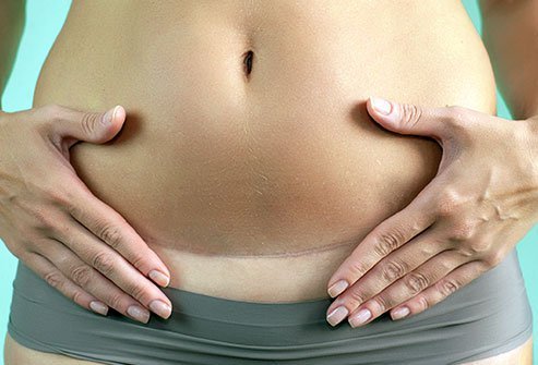 Cesarean delivery is a surgery to deliver a baby through a surgical cut (incision) on the abdomen and uterus.