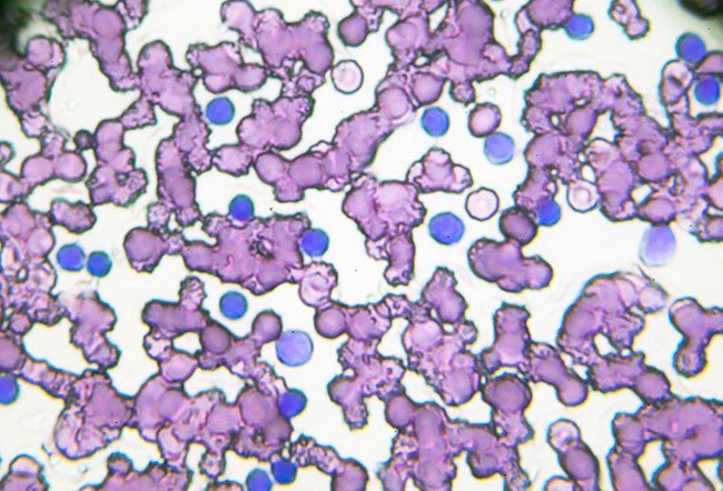 chronic lymphocytic leukemia (CLL)