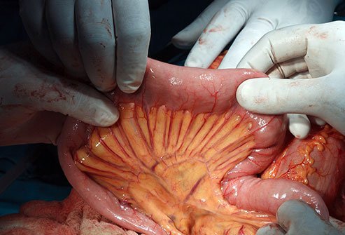 An intestinal anastomosis is the opening between two parts of the gastrointestinal tract. Surgeons must sometimes remove diseased parts and reconnect the healthy parts with an opening for food to pass through.