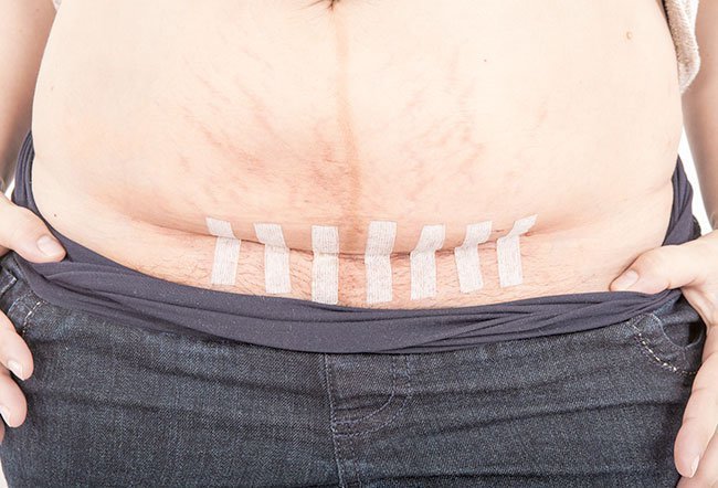 Abdominal Incisions