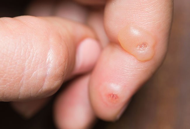 Warts are small skin growths that are usually harmless and that are caused by the human papillomavirus.