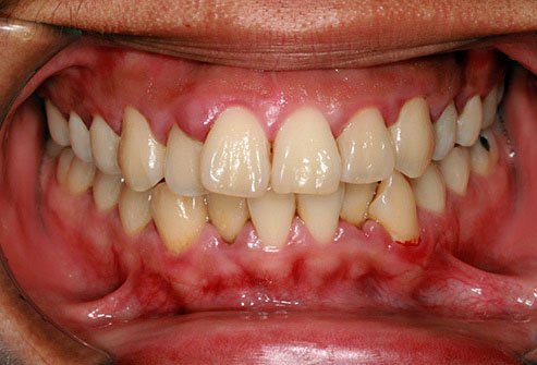 Gum disease is one of the more common causes of bad breath. 