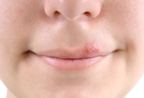 Some of the triggers of a cold sore