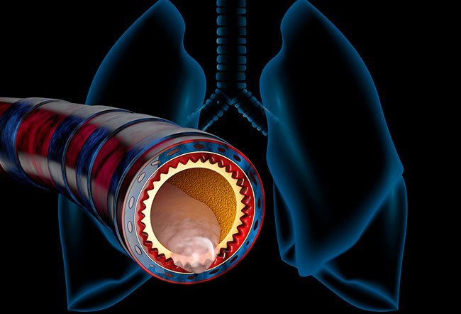 Mucus buildup in the lungs can be cased by infection, gastroesophageal reflux disease (GERD), smoking, cystic fibrosis, allergies, bronchiectasis, and chronic obstructive pulmonary disease (COPD).