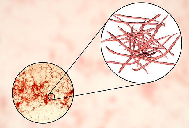what causes actinomycosis