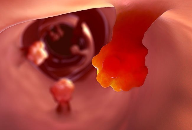 GIST Tumors