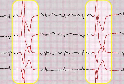 Continuous heart palpitations caused by PVCs may be dangerous.