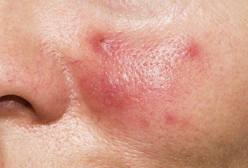 This skin condition is not blushing, although it may look like it.