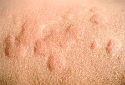 A hot flash is common with a serious reaction called anaphylaxis as your immune system releases cells to try to fight off something that is actually harmless.