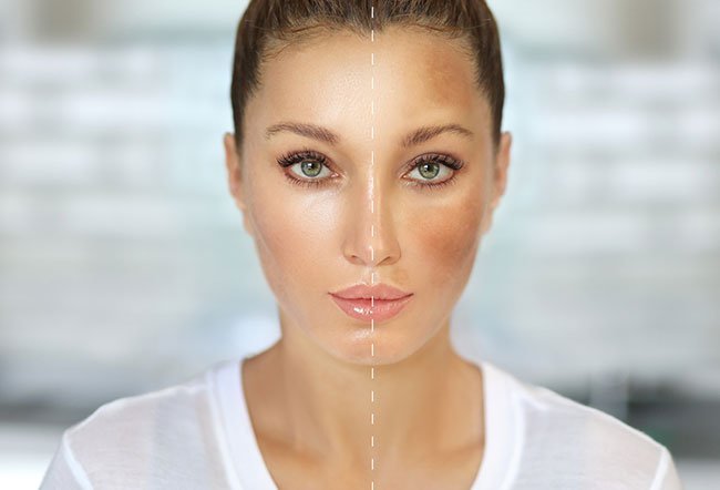 Some cases of hyperpigmentation may fade on their own. Some medications can also help with hyperpigmentation. They may be used alone or combined, which may be more effective.