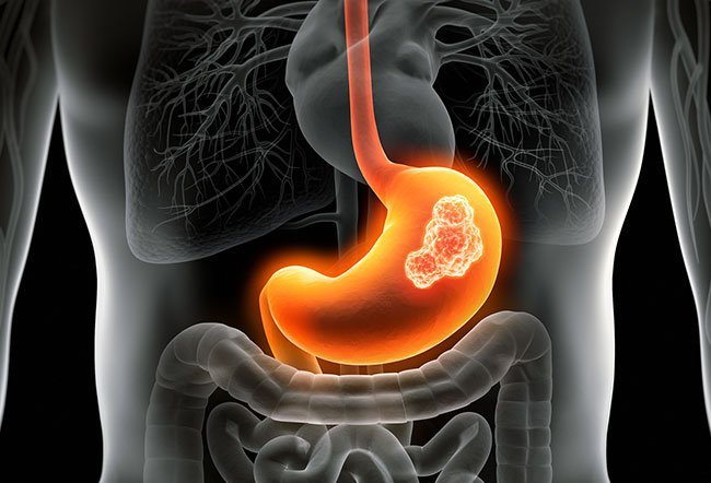 Kaposi carcoma (KS) is a form of cancer caused by herpesvirus infection. Kaposi sarcoma is caused by immune suppression, HIV infection and certain socioeconomic factors.