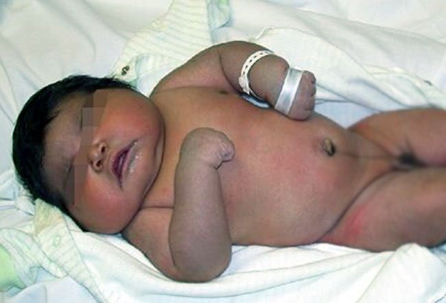 Newborn boy with macrosomia images
