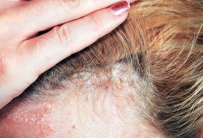 scalp psoriasis triggers