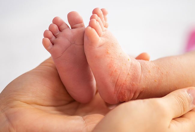 A baby's skin is delicate and can easily break into rashes in response to various irritants. Rashes on a baby's skin may be caused by miliaria, baby oil or soaps, viruses, bacteria, fungi, excessive dryness, moisture, insect bites, food allergy and exposure to heat and sun. 