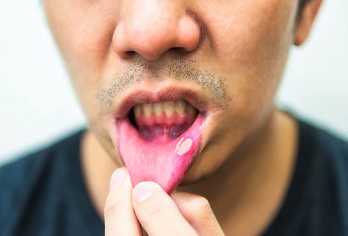 Canker sores are small open ulcers that usually appear on the inside of your mouth. Causes include stress, hormonal changes, nutritional deficiencies, foods and other more. They usually heal on their own and don't require any treatment but can sometimes point toward an underlying issue. 