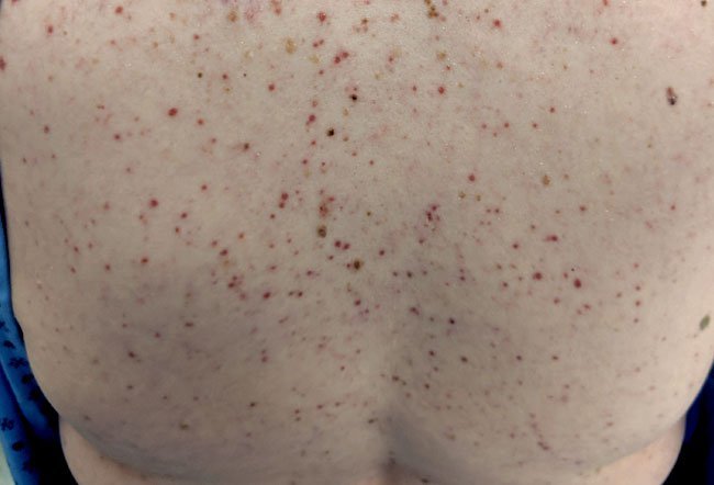 Causes of urticaria pigmentosa symptoms include: rubbing the skin, drinking hot liquids or eating spicy food, exercise, exposure to sunlight or cold, and medications such as aspirin or other NSAIDs, morphine, codeine, alcohol, x-ray dye, and some anesthesia medicines.