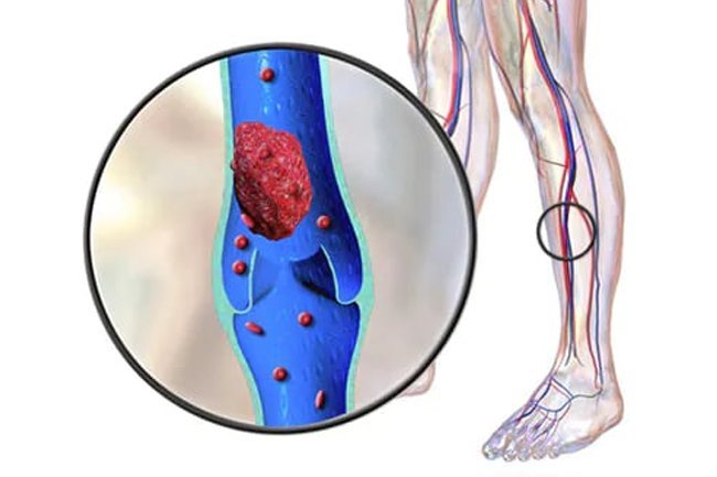 Brain tumors release chemicals that may make you more likely to form blood clots.