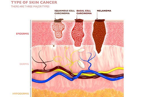 Melanoma is the most aggressive of skin cancers. Changes in the skin, changes in existing moles and non-healing sores are all early signs of melanoma.