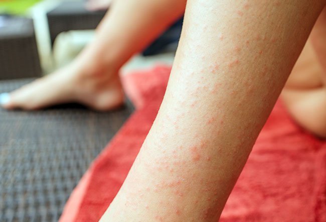 Dermatitis herpetiformis (DH) or Duhring's disease looks similar to herpes lesion