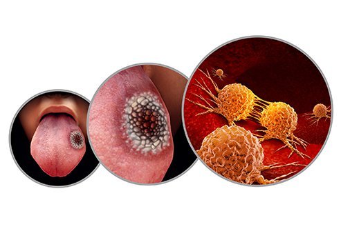 Cancer on the tongue first appears as a pinkish-red lump or sore on the sides of tongue 